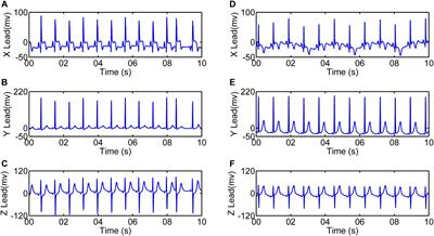 R-Wave Singularity: A New Morphological Approach to the Analysis of Cardiac Electrical Dyssynchrony